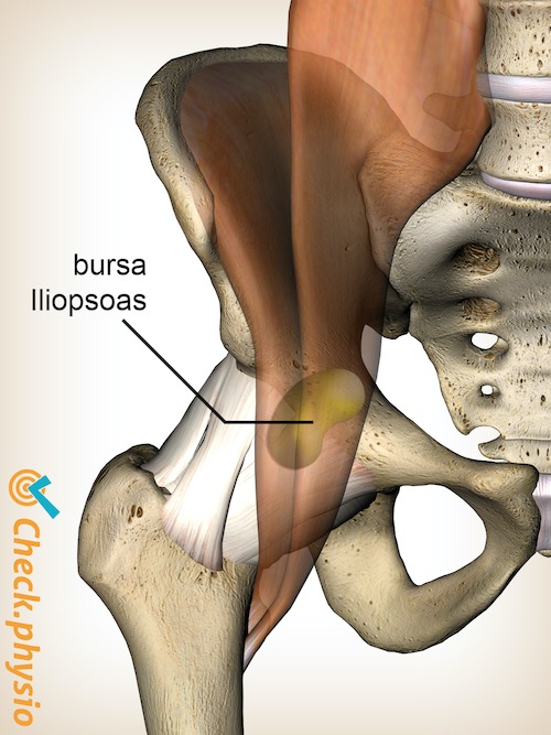 cadera iliopsoas bursitis de la bursa