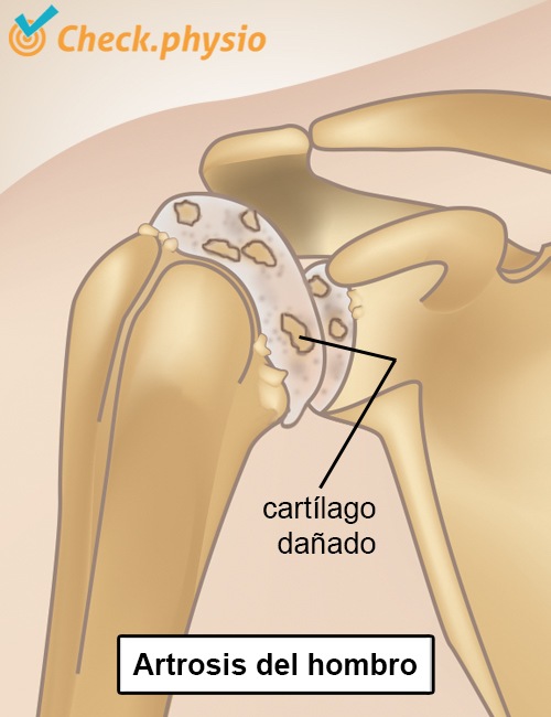 arteriosclerosis del hombro