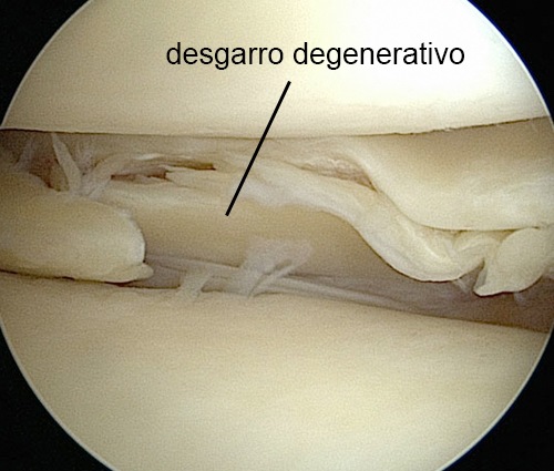 rodilla degeneración menisco deteriorado