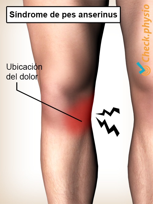 rodilla síndrome de pes anserine ubicación del dolor