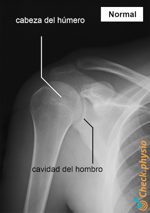 hombro radiografía normal