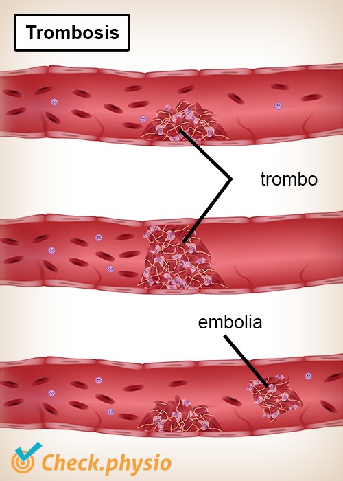 Trombosis de la pierna | Physio Check