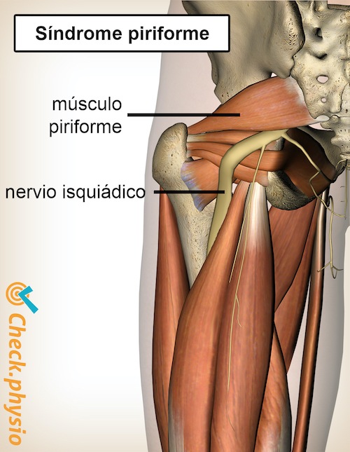 glúteo glúteo síndrome piriforme anatomía