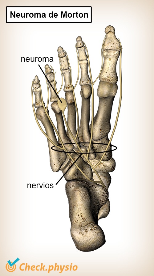 pie neuroma de morton