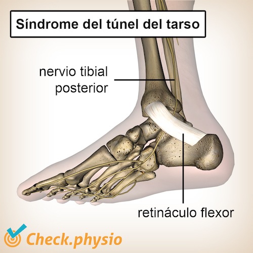 pie síndrome del túnel tarsiano nervio tibial posterior retináculo flexor