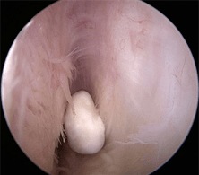 artroscopia de cuerpo libre intraarticular