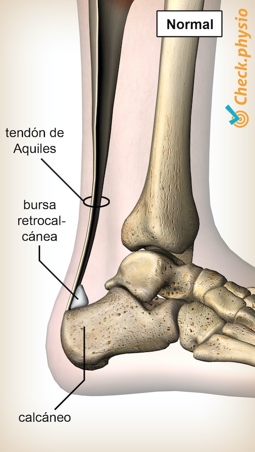 tobillo tendón de aquiles bursa retrocalcánea calcáneo hueso del talón