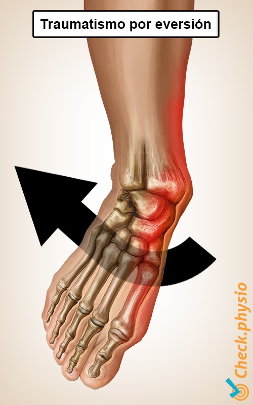 tobillo traumatismo por inversión