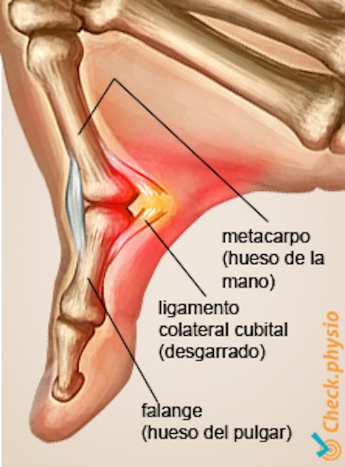 mano pulgar de esquiador anatomía ligamento colateral cubital