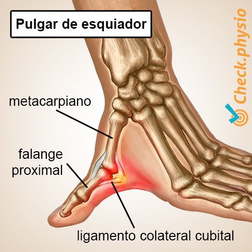 mano pulgar de esquiador