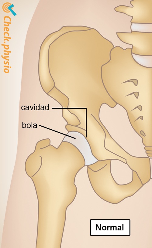 artrosis de cadera saludable