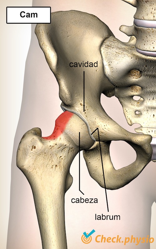 cadera pinzamiento femoroacetabular fai cam