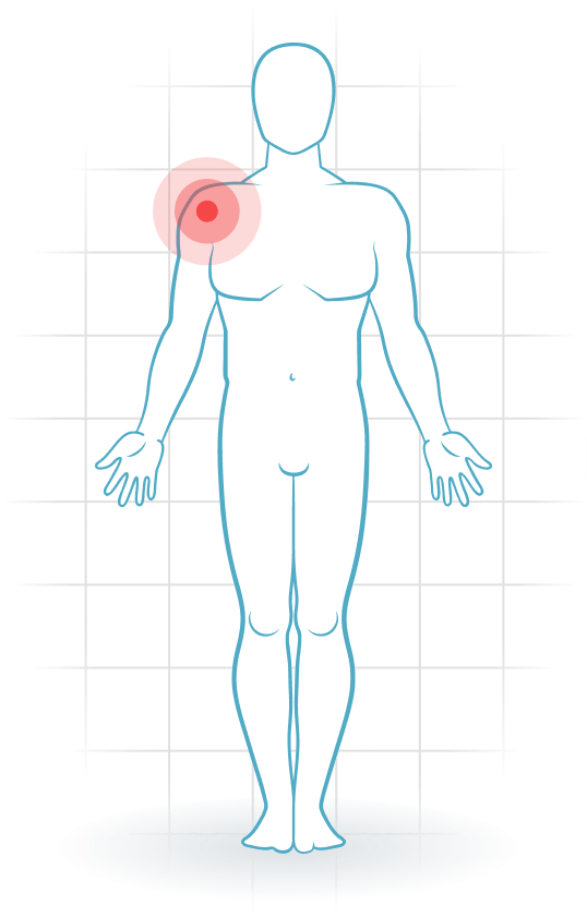 pijnlocatie Tendinopatía subescapular