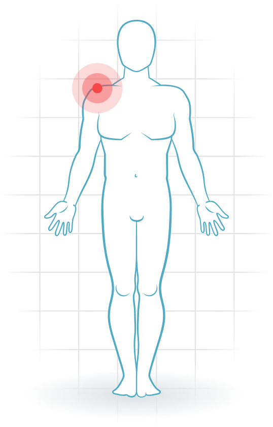 pijnlocatie Lesión acromioclavicular